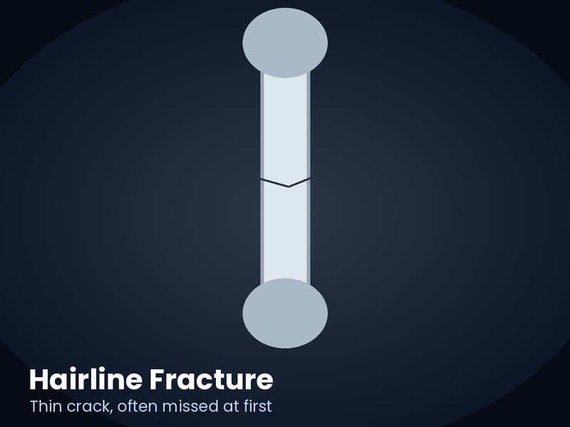 X-ray style illustration of a hairline fracture, a thin crack in a bone