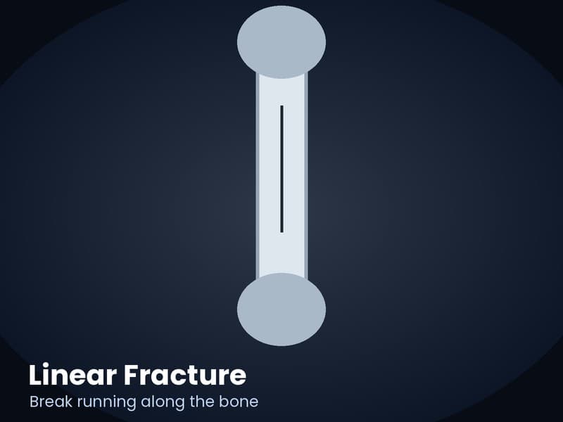 X-ray style illustration of a linear fracture running along the length of a bone