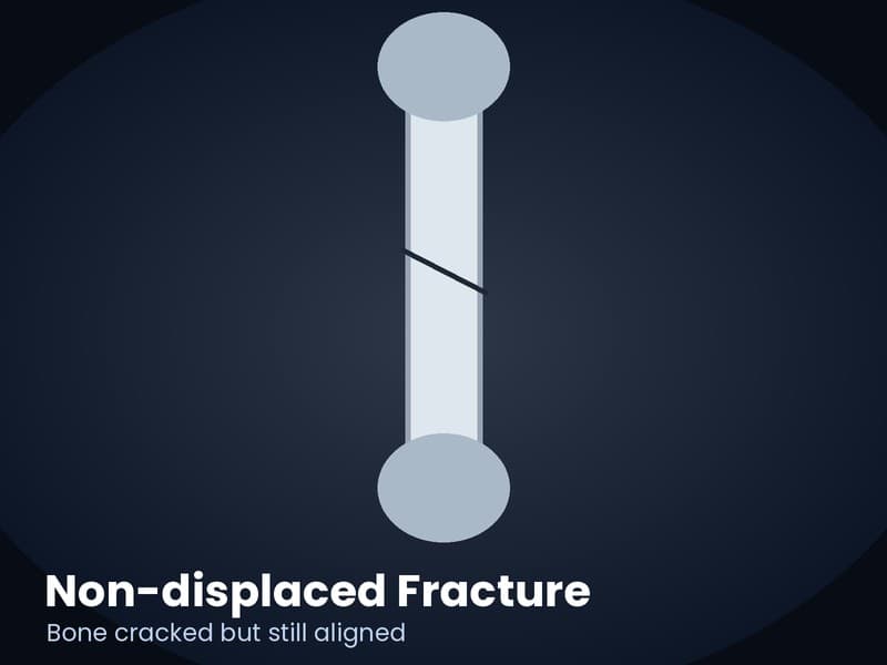 X-ray style illustration of a non-displaced fracture where the bone is cracked but still in line